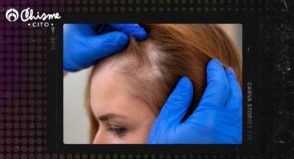 Alopecia: recupera tu cabello con 3 ingredientes de cocina