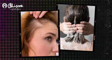 Alopecia: haz que crezca el cabello, solo con un shampoo de 4 ingredientes