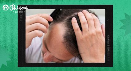 Alopecia: 3 formas de peinar el cabello para que no se note su caída