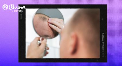 Alopecia: 5 vitaminas que le faltan a tu cuerpo cuando se cae el cabello