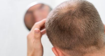 Alopecia: 5 alimentos ricos en hierro que previenen la caída del cabello