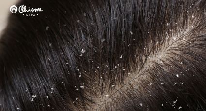 Despídete de la caspa con estos 3 remedios naturales para un cabello con brillo