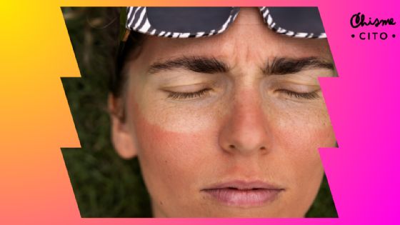 ¿Más rojo que camarón cocido? Así puedes remediar el ardor por quemaduras de sol fácil y rápido
