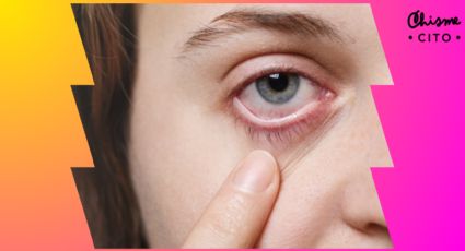 ¿Te salió una perrilla en el ojo? No gastes de más, así de fácil puedes eliminarla