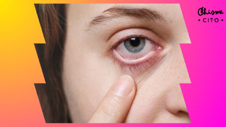 ¿Te salió una perrilla en el ojo? No gastes de más, así de fácil puedes eliminarla