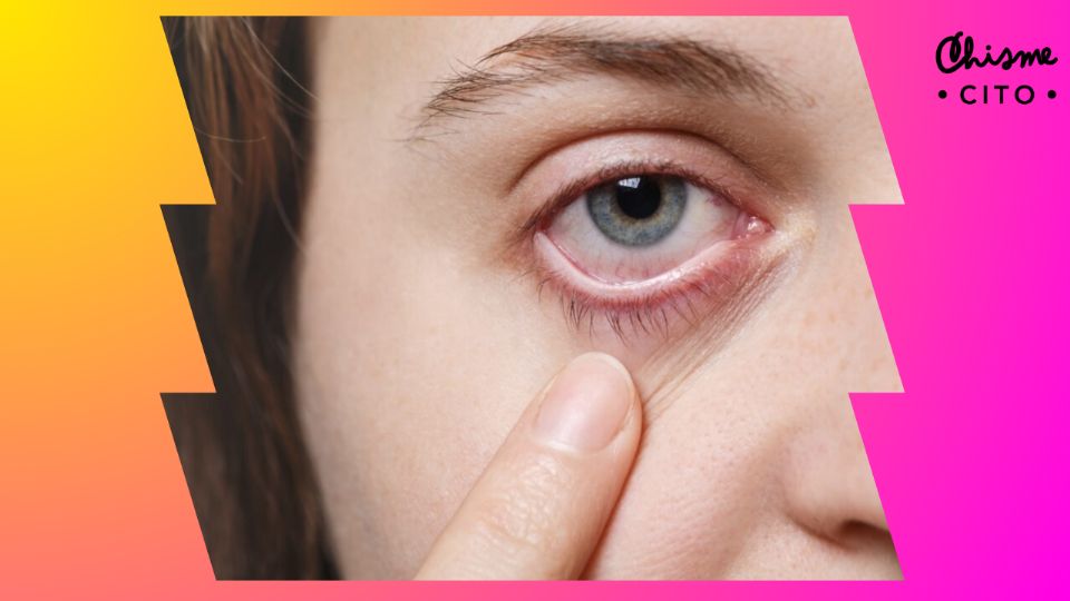 ¿Que son las perrillas y cómo aliviarlas? Aquí te compartimos algunos consejos.