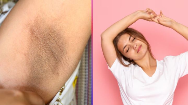 Axilas oscuras: por qué aparecen las manchas y cómo aclararlas de forma segura, según dermatólogos