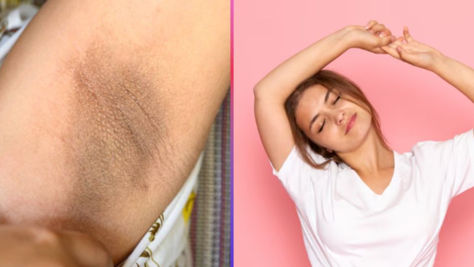 Las manchas en tus axilas se pueden tratar con el cuidado adecuado.
