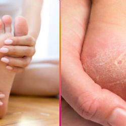 ¿Cómo eliminar los callos de los pies de forma efectiva y rápida? El remedio casero que sí funciona