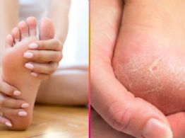 ¿Cómo eliminar los callos de los pies de forma efectiva y rápida? El remedio casero que sí funciona