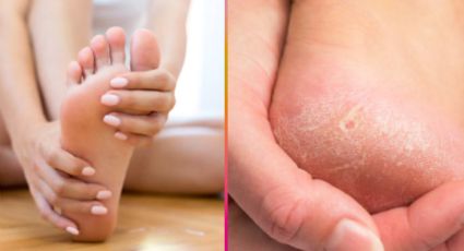 ¿Cómo eliminar los callos de los pies de forma efectiva y rápida? El remedio casero que sí funciona