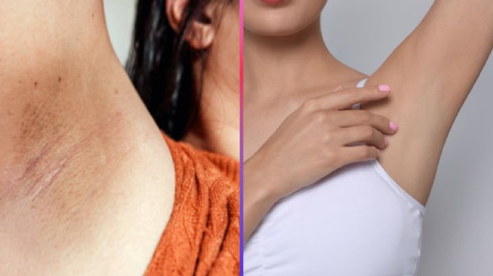 ¿Axilas oscuras? El remedio casero con dos ingredientes para aclararlas de forma natural
