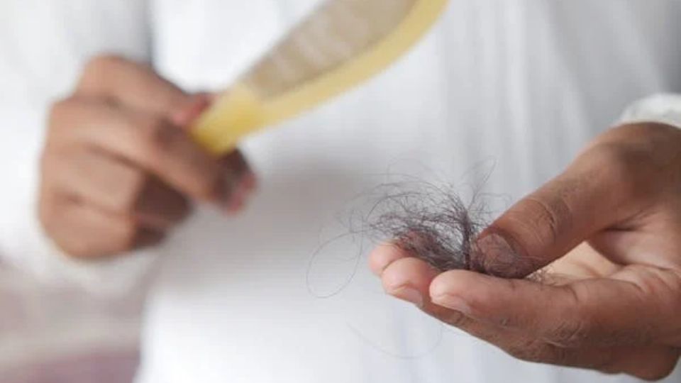 La alopecia puede ser un verdadero problema para el cabello.