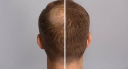 Alopecia: olvídate de la caída del cabello y fortalece tu pelo solo haciendo masajes