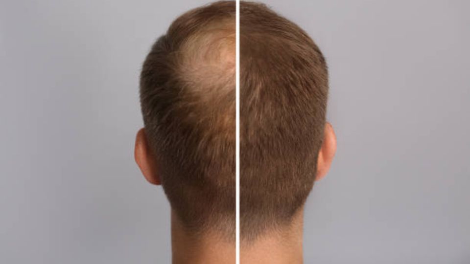 Alopecia