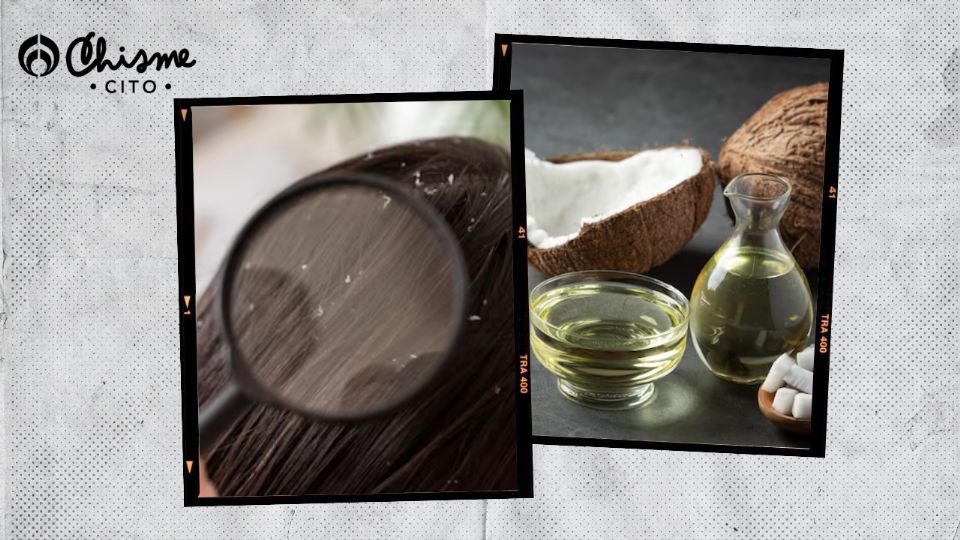 La caspa en el cabello se puede eliminar con aceite de coco.