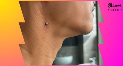 ¿Tienes verrugas? Estos son los métodos fáciles y baratos para eliminarlas