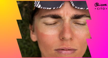 ¿Más rojo que camarón cocido? Así puedes remediar el ardor por quemaduras de sol fácil y rápido