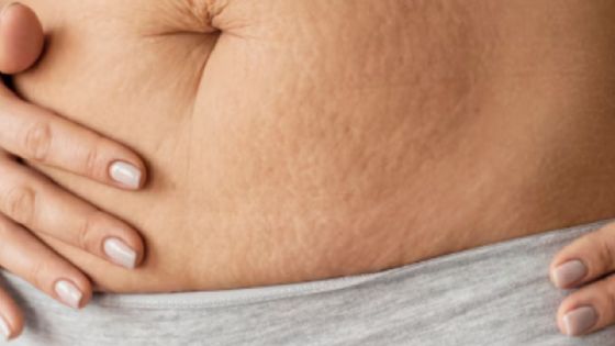 Estrías rojas: ¿qué son, por qué aparecen y cómo eliminarlas con productos baratos?