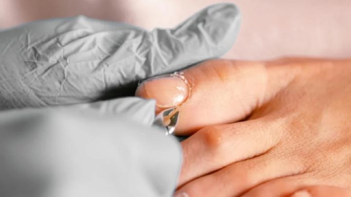 Uñas enterradas: estos son los mejores consejos para tratarlas y prevenirlas