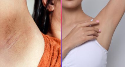 ¿Axilas oscuras? El remedio casero con dos ingredientes para aclararlas de forma natural
