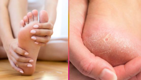 ¿Cómo eliminar los callos de los pies de forma efectiva y rápida? El remedio casero que sí funciona